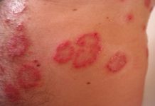 psoriasis_huidaandoening