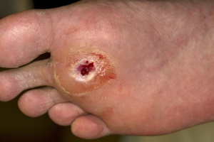 diabetes-voet ulcer